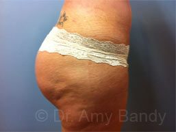 Brazillian Butt Lift Before & After Patient #389