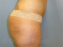 Brazillian Butt Lift Before & After Patient #389