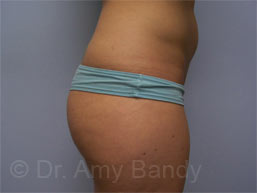 Brazillian Butt Lift Before & After Patient #386