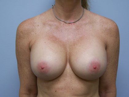 Breast Augmentation Before & After Patient #3430