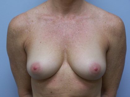 Breast Augmentation Before & After Patient #3430