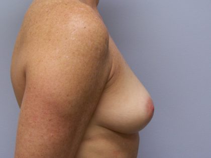Breast Augmentation Before & After Patient #3430