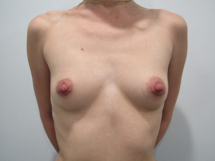 Breast Augmentation Before & After Patient #3154