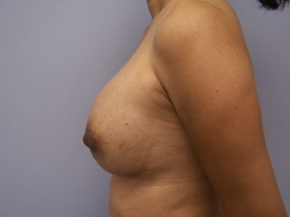 Breast Implant Exchange Before & After Patient #6004