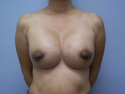 Breast Implant Exchange Before & After Patient #6004
