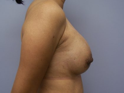 Breast Implant Exchange Before & After Patient #6004