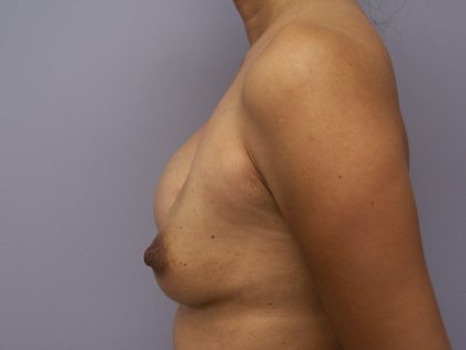 Breast Implant Exchange Before & After Patient #6004
