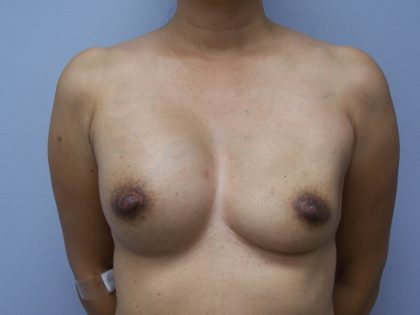 Breast Implant Exchange Before & After Patient #6004