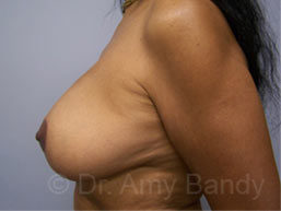 Breast Lift With Implant Removal Before & After Patient #11752