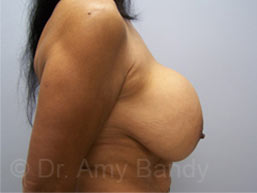Breast Lift With Implant Removal Before & After Patient #11752