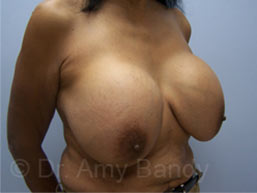 Breast Lift With Implant Removal Before & After Patient #11752