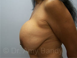 Breast Lift With Implant Removal Before & After Patient #11752