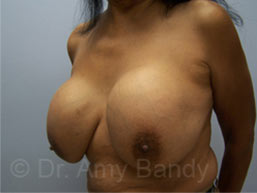 Breast Lift With Implant Removal Before & After Patient #11752