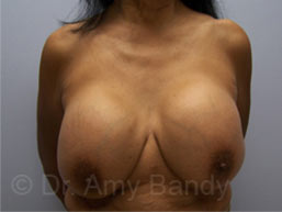 Breast Lift With Implant Removal Before & After Patient #11752