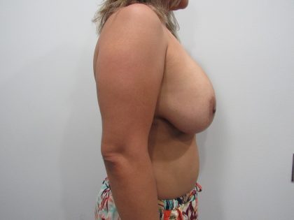 Breast Lift With Implant Removal Before & After Patient #11713