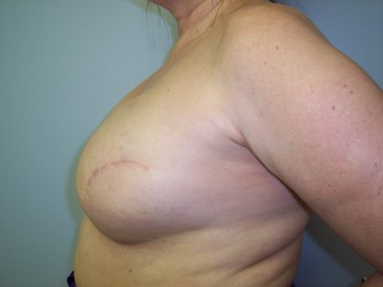 Breast Reconstruction Before & After Patient #6727