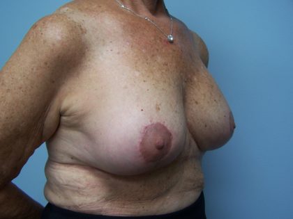 Breast Reduction Before & After Patient #6792