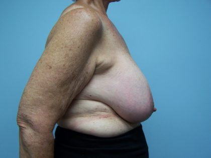 Breast Reduction Before & After Patient #6792