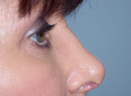 Eyelid Lift Before & After Patient #6851