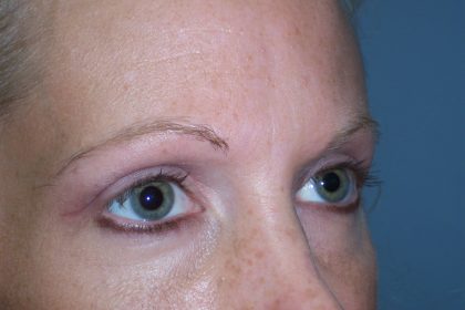 Eyelid Lift Before & After Patient #6848