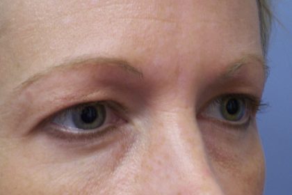 Eyelid Lift Before & After Patient #6848