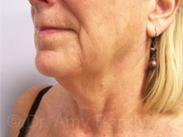 Face & Neck Lift Before & After Patient #7114