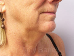 Face & Neck Lift Before & After Patient #7114