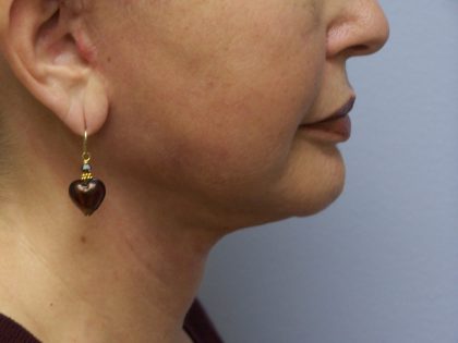 Face & Neck Lift Before & After Patient #7097