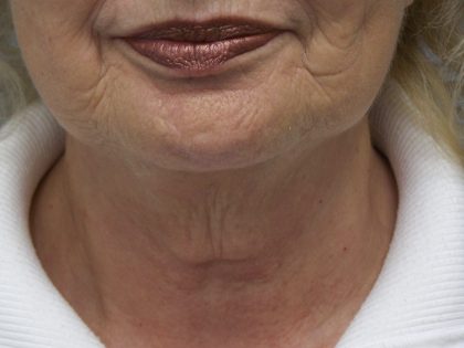 Face & Neck Lift Before & After Patient #7097