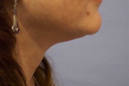 Face & Neck Lift Before & After Patient #7080