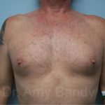 Gynecomastia Before & After Patient #7590