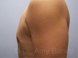 Gynecomastia Before & After Patient #7576