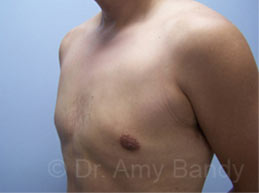 Gynecomastia Before & After Patient #7576