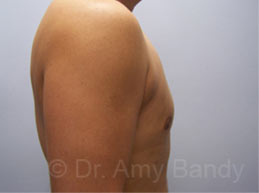 Gynecomastia Before & After Patient #7576