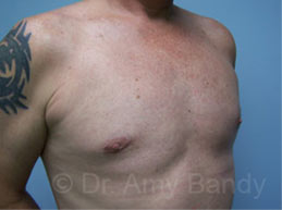 Gynecomastia Before & After Patient #7576