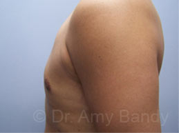 Gynecomastia Before & After Patient #7576