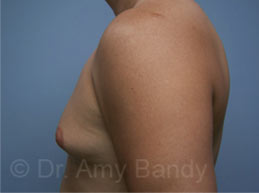 Gynecomastia Before & After Patient #7576
