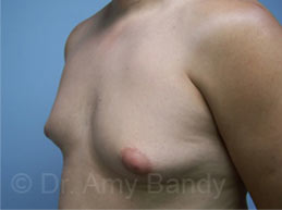 Gynecomastia Before & After Patient #7576