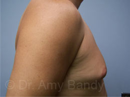 Gynecomastia Before & After Patient #7576