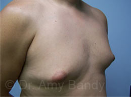 Gynecomastia Before & After Patient #7576