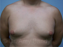 Gynecomastia Before & After Patient #7576