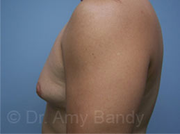 Gynecomastia Before & After Patient #7576