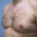 Gynecomastia Before & After Patient #7562