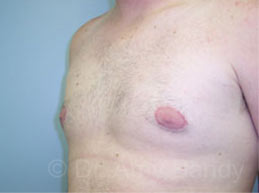Gynecomastia Before & After Patient #7543