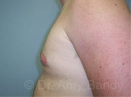 Gynecomastia Before & After Patient #7543