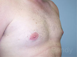 Gynecomastia Before & After Patient #7543