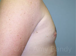 Gynecomastia Before & After Patient #7543