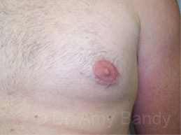 Gynecomastia Before & After Patient #7543