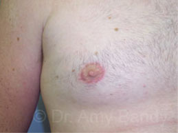 Gynecomastia Before & After Patient #7543