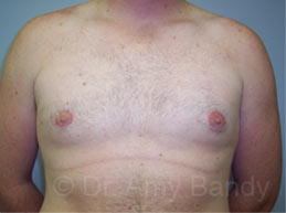 Gynecomastia Before & After Patient #7543